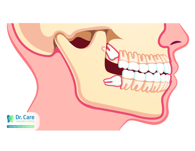 mọc răng khôn có nguy hiểm không