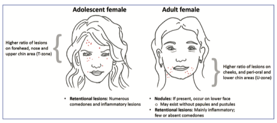 Cómo se diagnostica el acné
