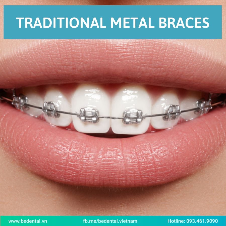 Metal braces