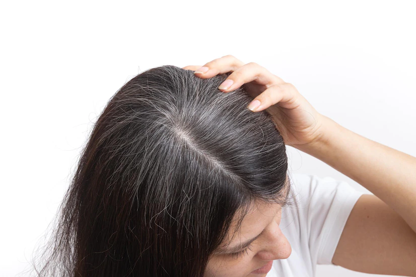 Lý do tóc bạc sớm - căng thẳng, stress
