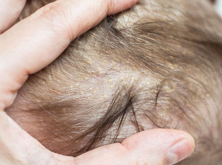 Viêm da tiết bã da đầu có hiện tượng da bong vẩy từng lớp thường gọi là gàu