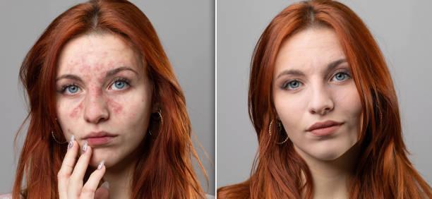 Before and after of a successful laser rosacea removal treatment Before and after a rosacea laser treatment. Successful removal of couperose from the face of a young woman. Red cheeks from inflamed capillaries of a Caucasian female. eczema face cream stock pictures, royalty-free photos & images