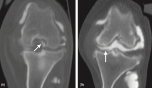 Obrázek 11: Kolenní kloub v 90° flexi zobrazen pomocí CT, oba kolenní klouby postiženy rupturou LCC, A) přidružen poškozený  meniskus v místě, kde se normálně nachází LCC, B) přidružen poškozený meniskus ohraničený kontrastní látkou (2)
