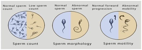 Low Sperm Quality or Quantity