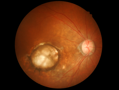 Close-up of Age-related macular degeneration. 