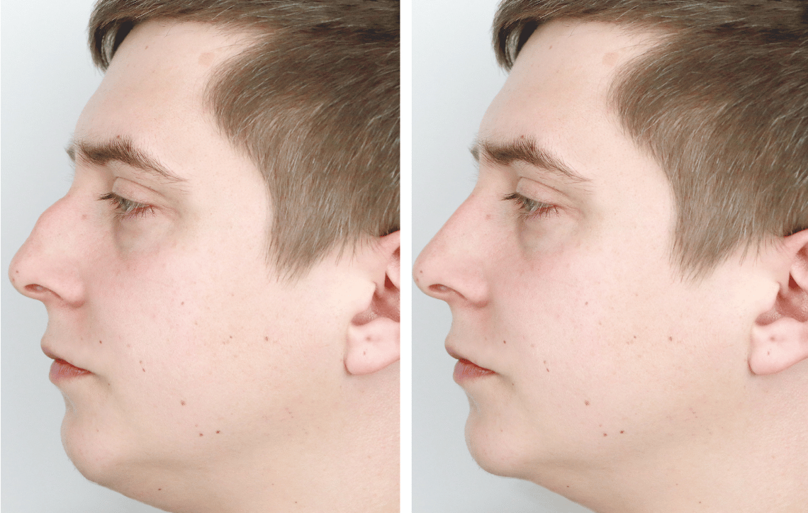 Man's nose side profile