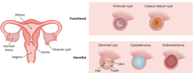 Causes of Ovarian Cyst After Hysterectomy