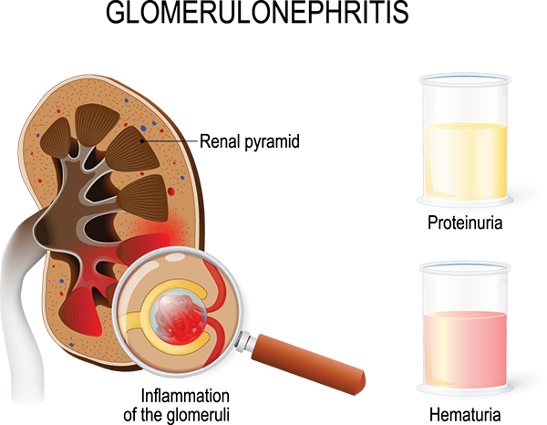 Post-Infectious Glomerulonephritis (PIGN) | National Kidney Foundation