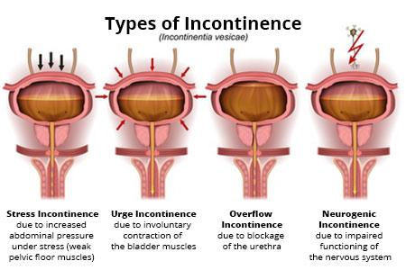 Incontinence - UROMED Products for More Quality of Life