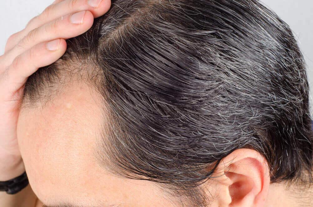 Erkeklerde Saç Dökülmesini Engelleme