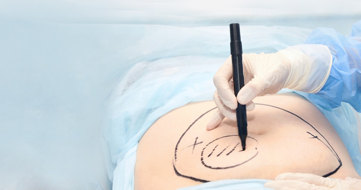 Can Liposuction Reduce High Blood Pressure