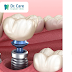 Các phương pháp phục hình răng phổ biến hiện nay