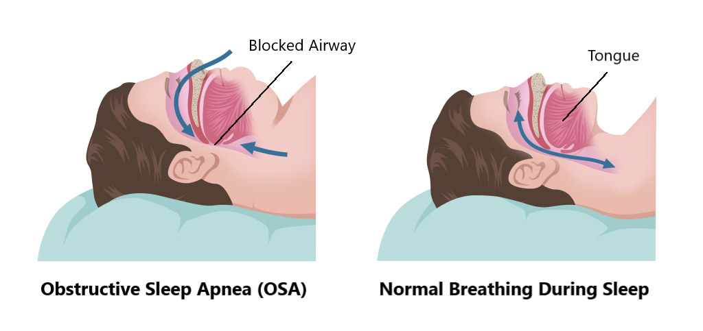 What is obstructive sleep apnea (OSA)?