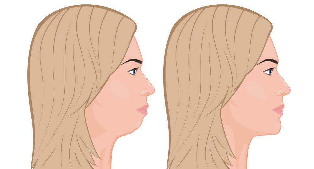 Comparison of a recessed chin profile and a normal profile