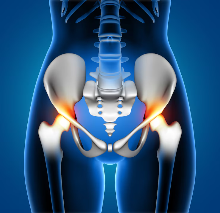 Stem Cell Therapy for Hip Replacement