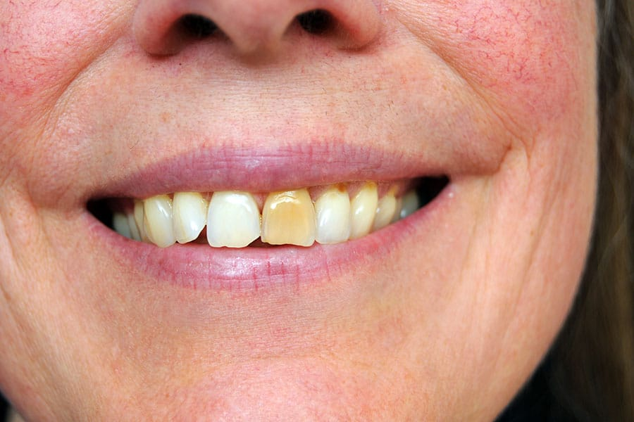 Teeth Whitening