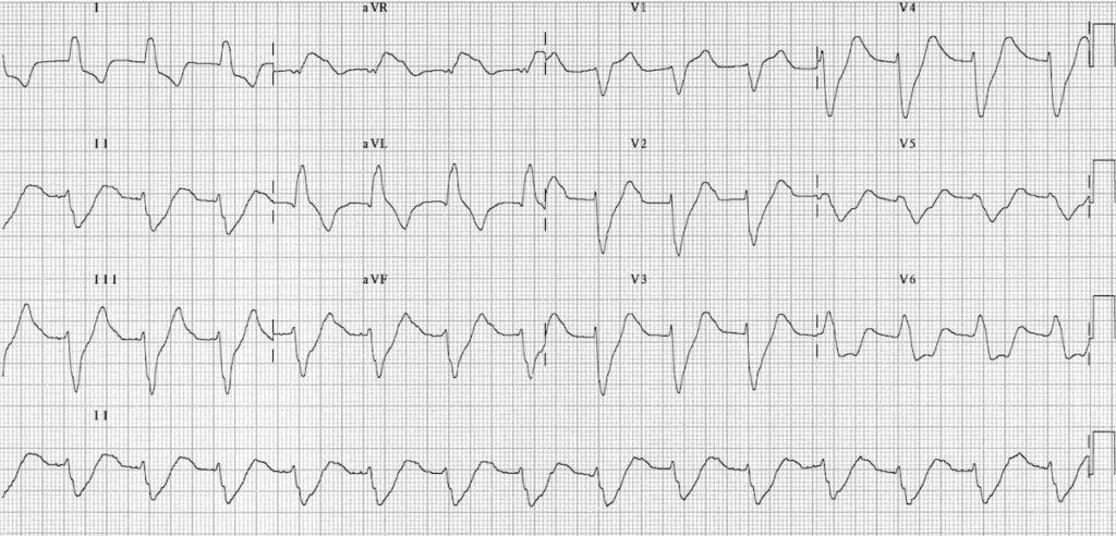 ECG Hyperkalemia broad QRS