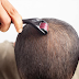 Microneedling for Hair Loss: Can It Help Stimulate Hair Growth?