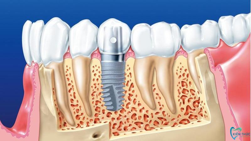 Trồng răng implant giá rẻ