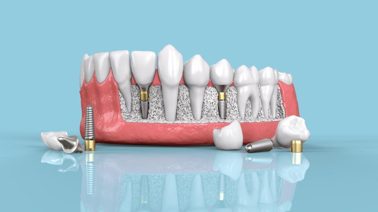  teeth implant clinic in Vancouver