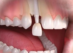 dental implants in Newmarket
