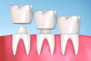 Bọc răng sứ là phương pháp thẩm mỹ nha khoa quen thuộc.