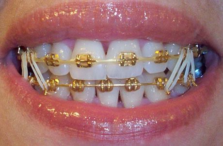 Gold braces colors