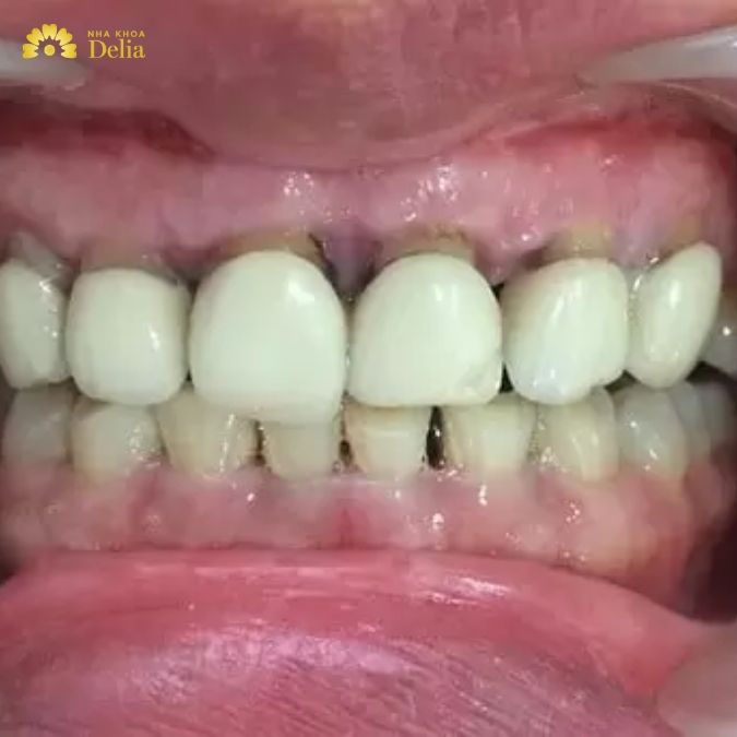 Răng sứ Trung Quốc