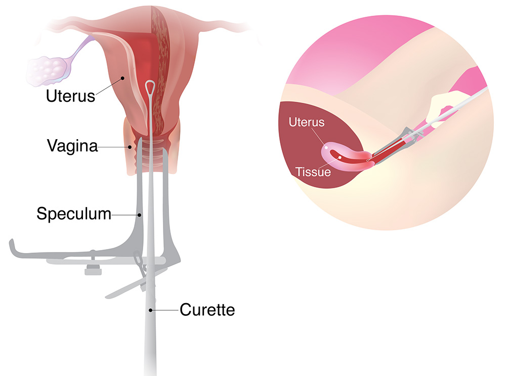 Dilation and Curettage (D&C)