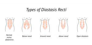 DIÁSTASIS ABDOMINAL