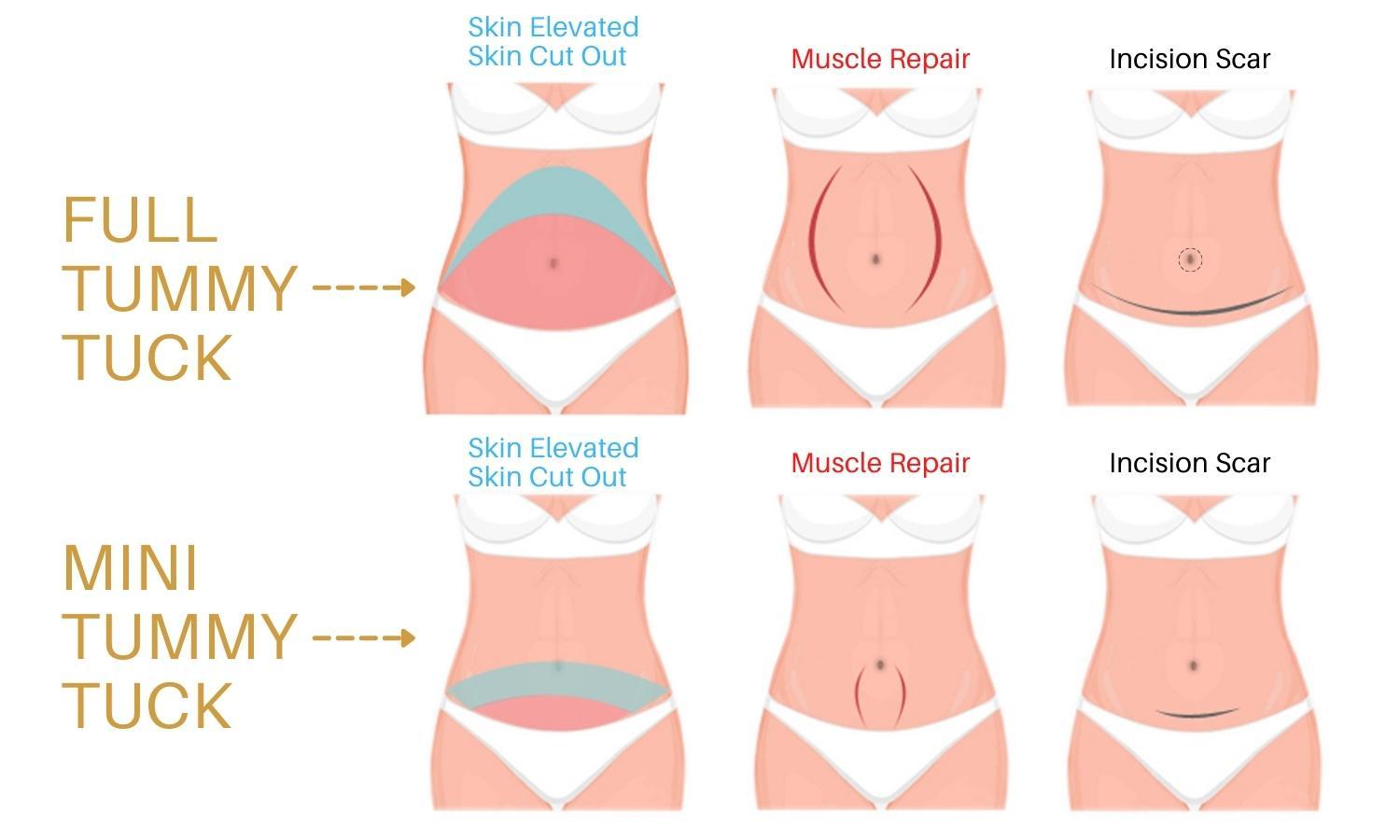 Mini Tummy Tuck vs. Full Tummy Tuck