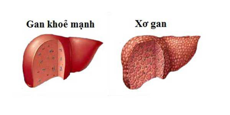 Gan nhiễm mỡ không do rượu không được điều trị kịp thời sẽ dẫn đến xơ gan