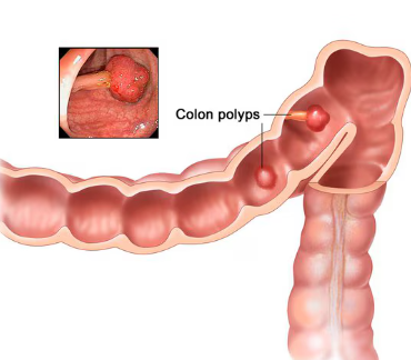 Understanding Colon Cancer