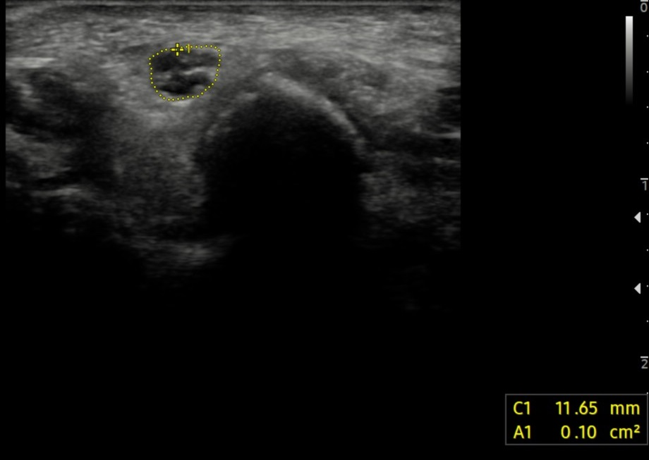 Ulnar Neuropathies - MSK - Medbullets Step 1