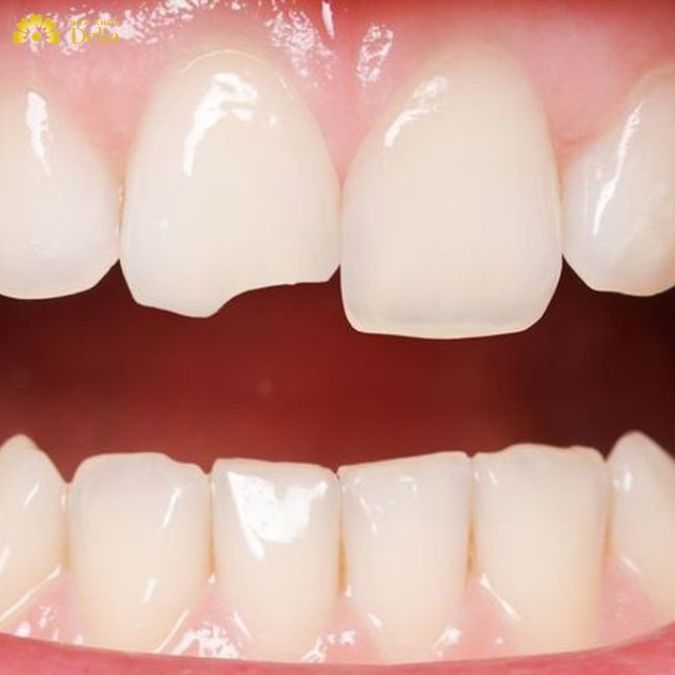 Việc ăn nhai, nghiền nát thức ăn không đảm bảo khi răng bị mẻ sứt