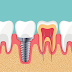 Cấy Ghép Implant Tức Thì Là Gì?