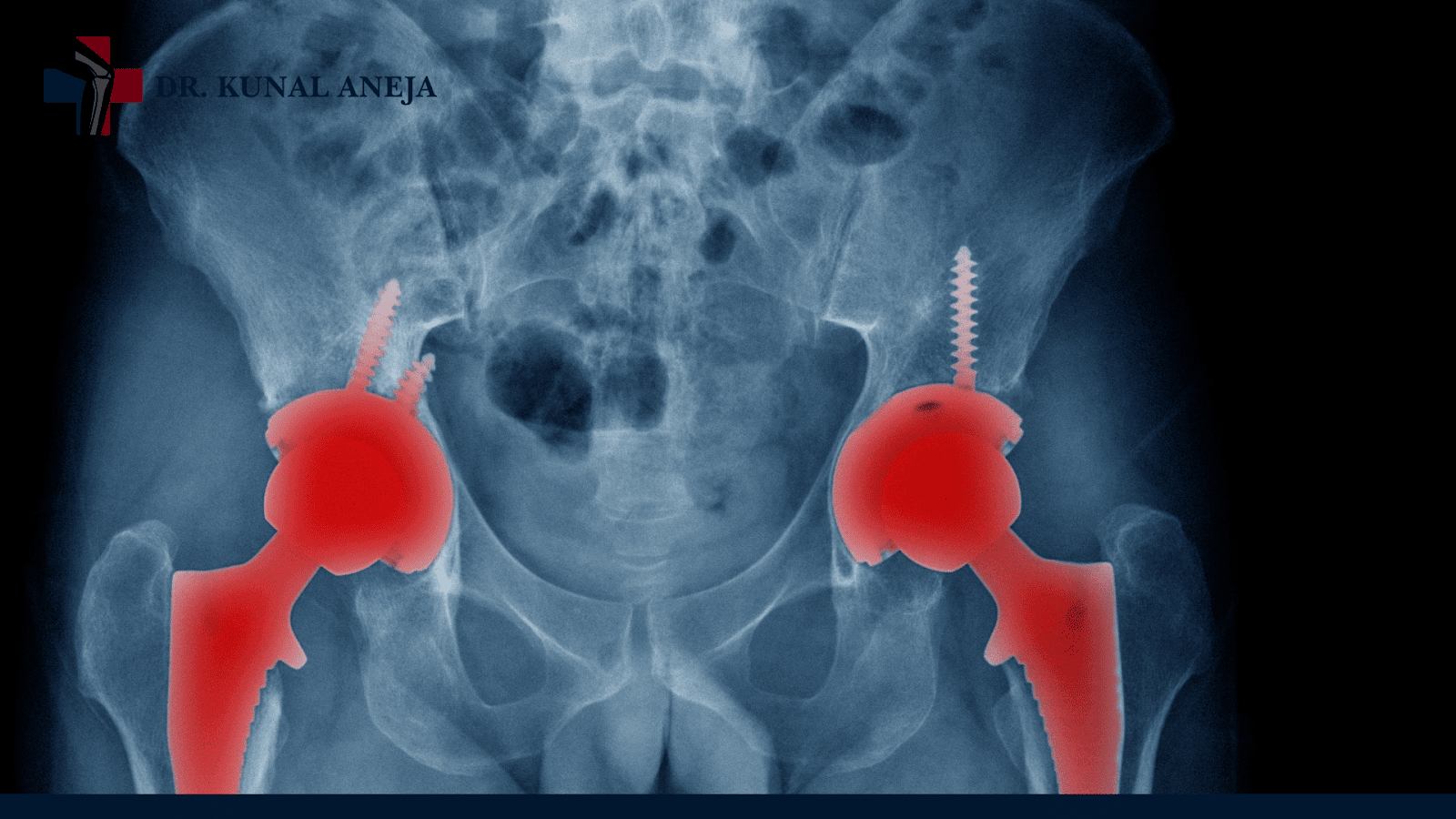 Hip Replacement Surgeon in Delhi
