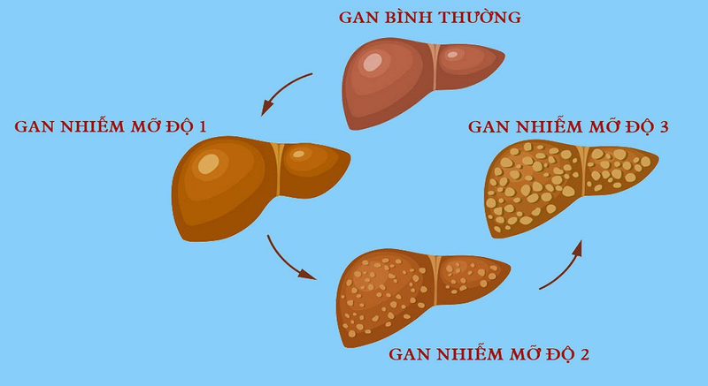 Tiến triển gan nhiễm mỡ ở bệnh tiểu đường