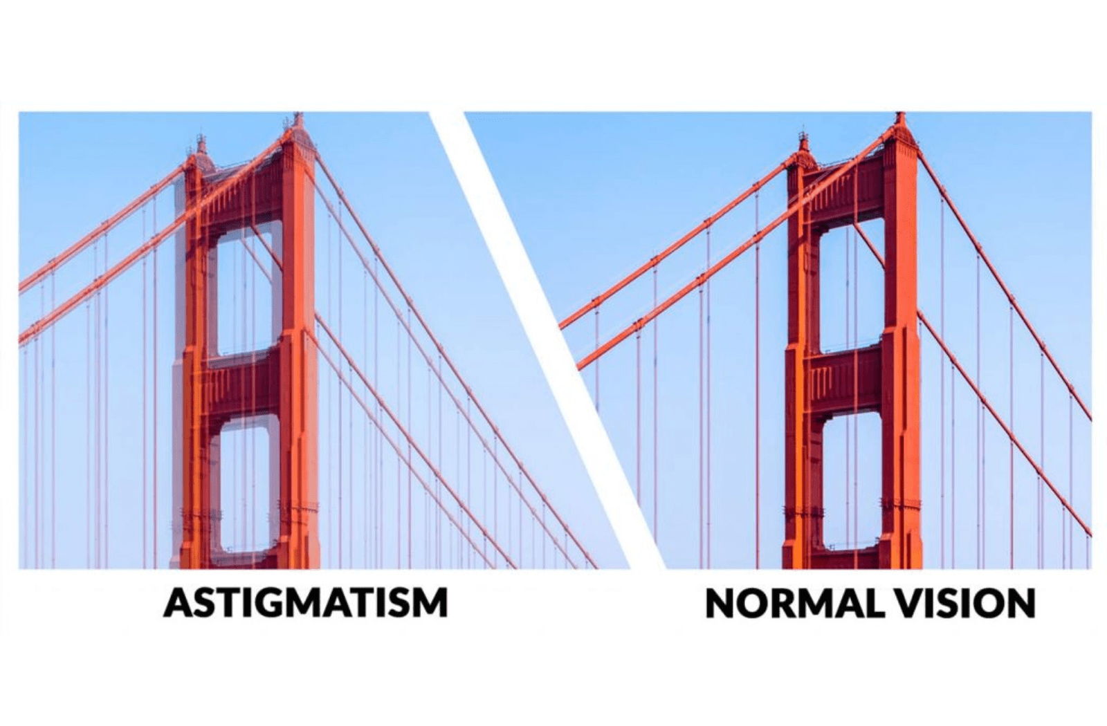Two similar images comparing what a bridge would look like with normal vision and what the bridge would look like if the person had astigmatism