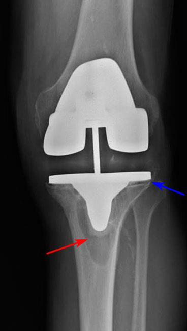 loose implant caused by osteolysis 