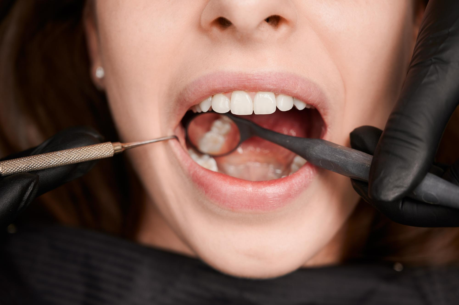 Hãy thăm khám răng thật kỹ trước khi tiến hành dán sứ