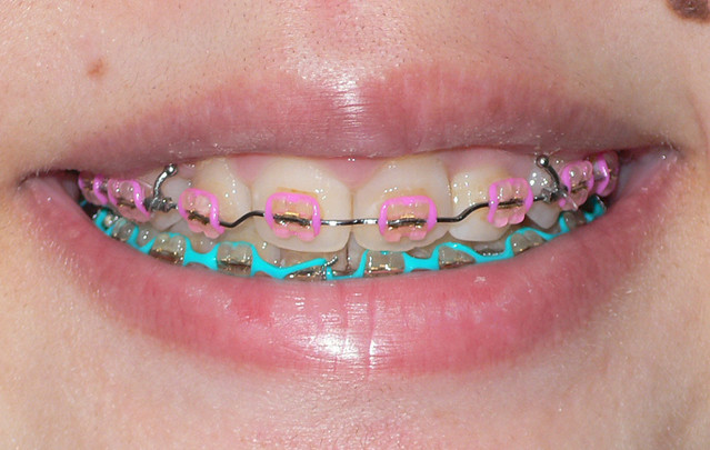 Alternating colored braces