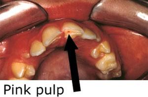 dental_trauma8