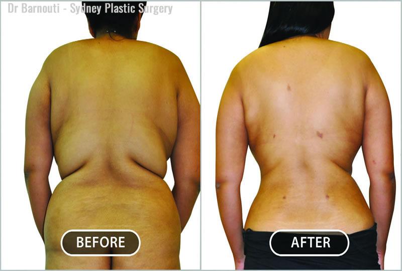 Love Handle Liposuction : cost, procedure, before and after