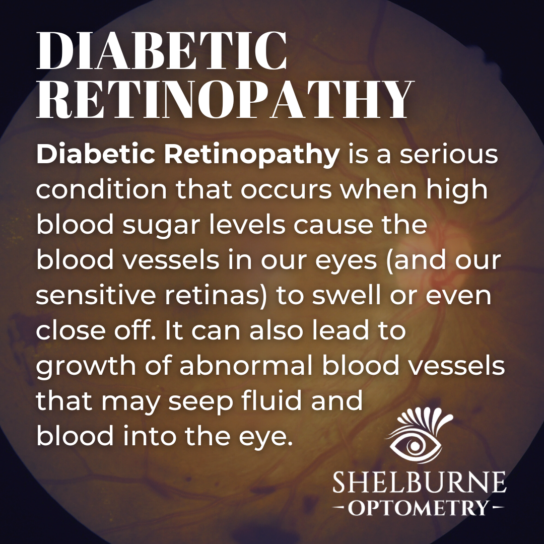 Diabetic Retinopathy is a serious condition that occurs when high blood sugar levels cause the blood vessels in our eyes and sensitive retinas to swell or even close off. It can also lead to growth of abnormal blood vessels that may seep fluid and blood into the eye.