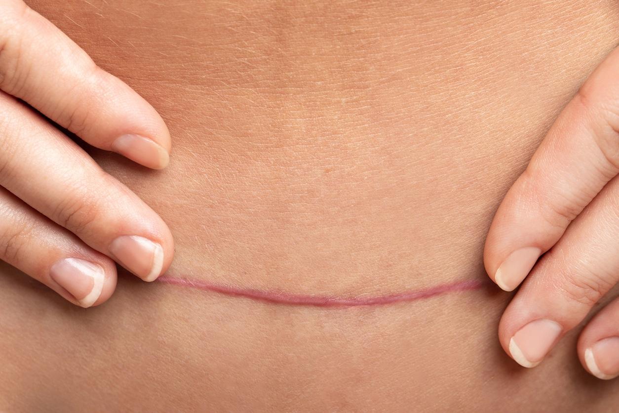 Qual é a aparência de uma cicatriz de abdominoplastia e quais são as suas variações?