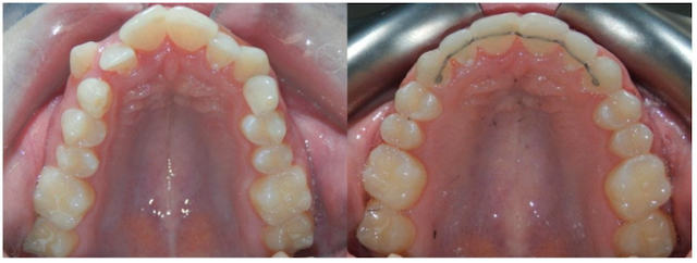 narrow palate with high arch