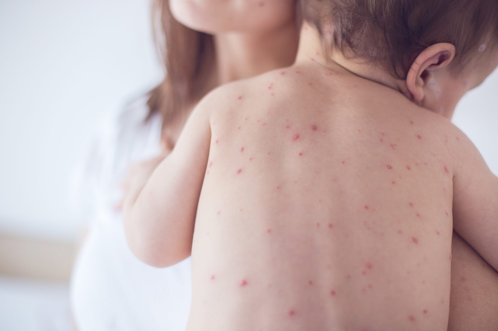 Các nốt ban đỏ trên da là triệu chứng điển hình của sốt xuất huyết