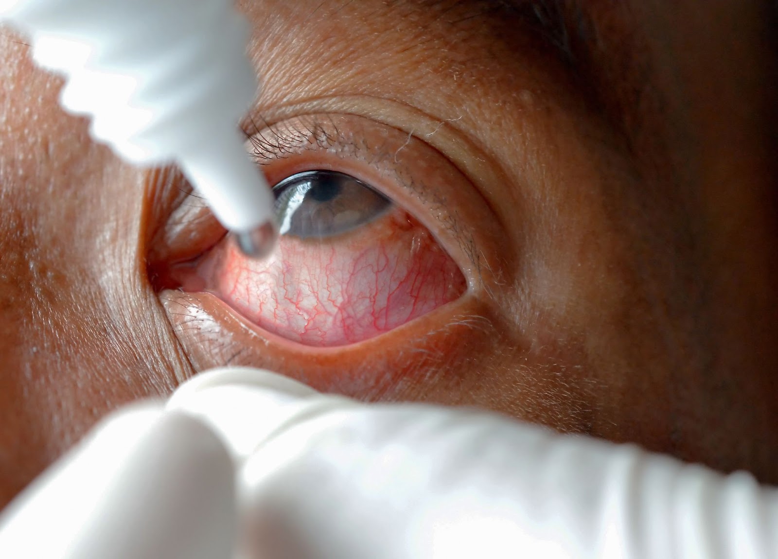 A close up shot of eye drops being put into an red, irritated-looking eye.
