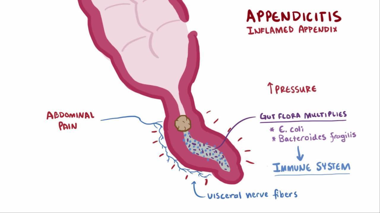 Appendicitis - Gastrointestinal Disorders - MSD Manual Professional Edition